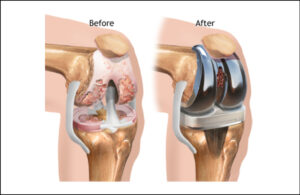 knee replacement (1)